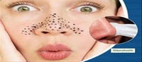 Most Effective Method to Remove Blackheads...